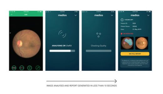 突破性研究显示Remidio Innovative Solutions设备筛查DR敏感度