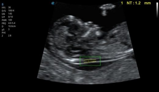 开立医疗：重视产检 避免“321”的遗憾