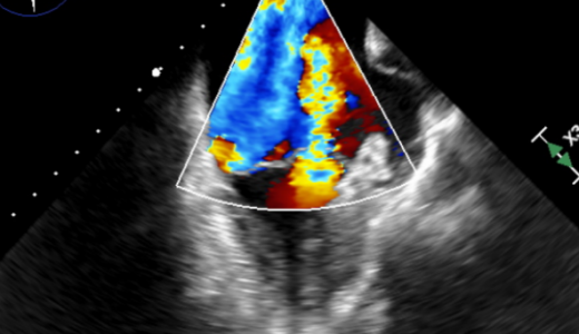 浙大二院应用DragonFly(TM)完成首例DMR二尖瓣修复手术