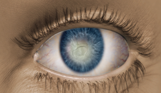 东沛制药治疗神经营养性角膜炎新药欧适维(R)中国获批