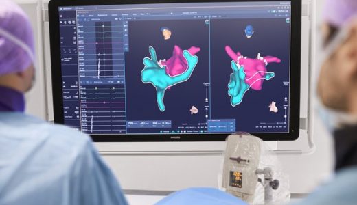 飞利浦宣布KODEX-EPD心脏成像和标测系统在中国正式上市