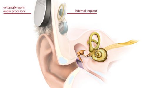 MED-EL完成欧洲首例全植入式人工耳蜗手术
