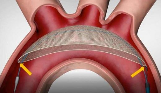 注册性临床结果公布,启明医疗TriGUARD 3(TM)达成主要安全终点