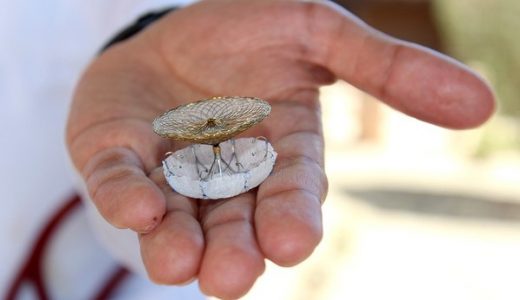 先健科技LAmbre左心耳封堵器成功救治美国特殊心耳高龄患者