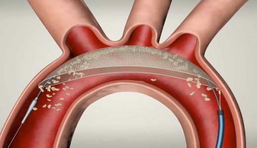 启明医疗TriGUARD3中国注册性临床试验顺利完成首例入组