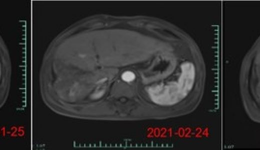 原启生物首个靶向肝癌CAR-T 细胞产品亮相ASCO