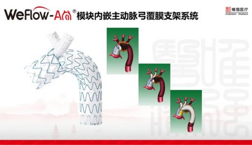 唯强医疗WeFlow-Arch主动脉弓覆膜支架系统中国注册临床试验顺利完成首例入组