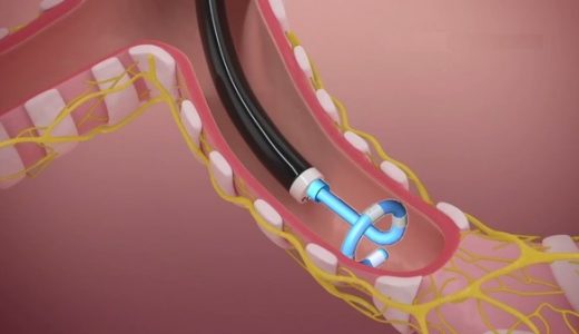 堃博医疗肺部靶向去神经射频消融能量系统完成首例临床应用