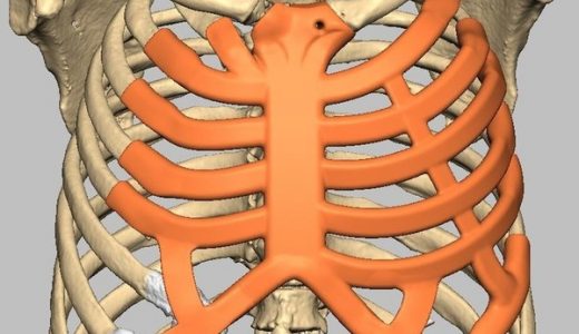 世界首款胸腔植入物在人体内“存活”