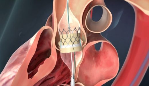 启明医疗新一代球扩干瓣Venus Vitae成功完成全球首两例临床应用