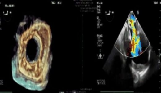 至鑫医疗完成介入二尖瓣置换产品动物实验