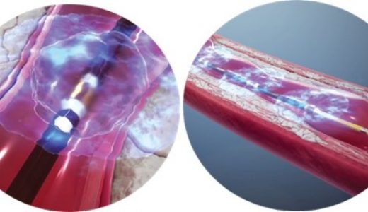 健适医疗“Shockwave血管内冲击波”治疗设备及导管获批上市