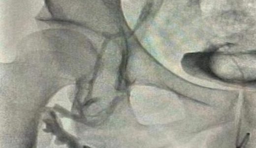 世界首位应用我国自主研发的血栓抽吸系统的患者顺利康复出院